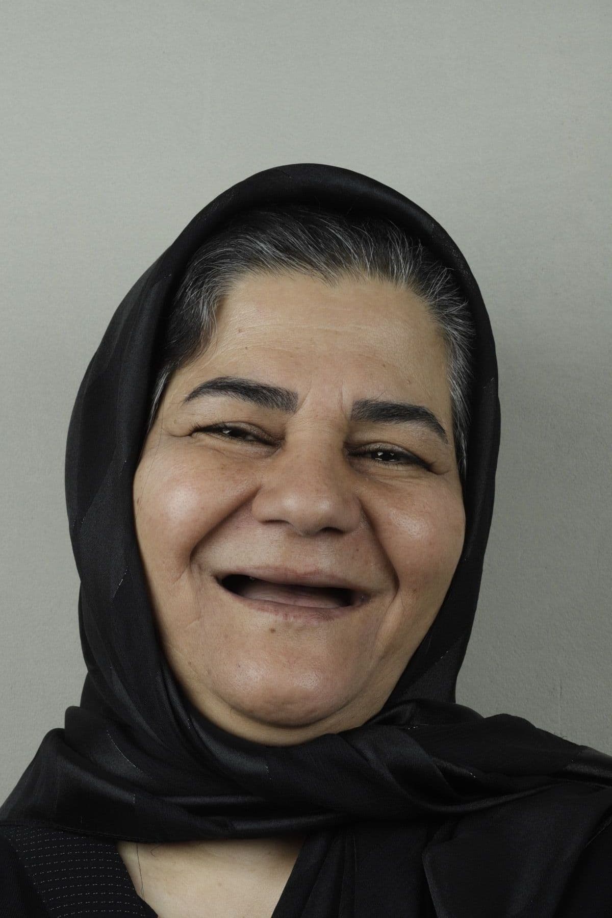 زینب غفاری پیش از بازسازی پروتزی دو فک